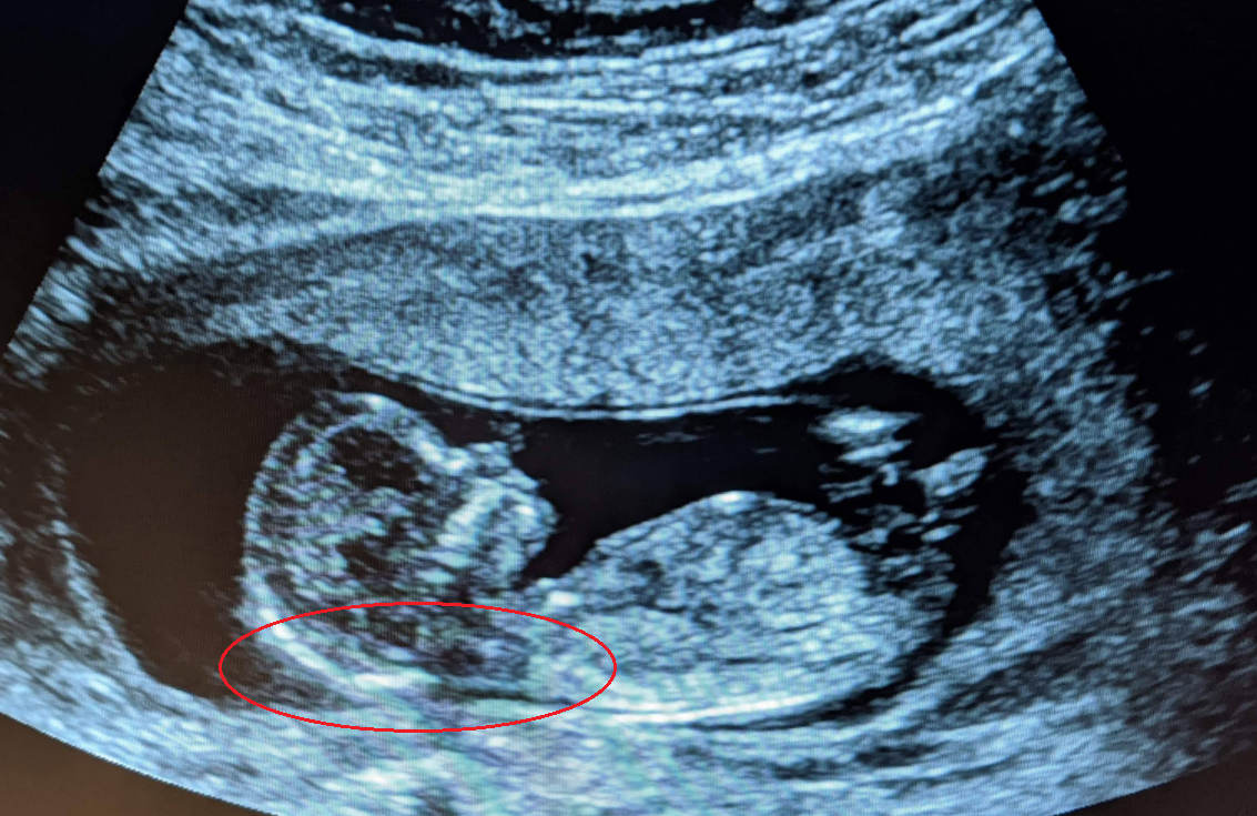 Nuchal translucency ultrasound result